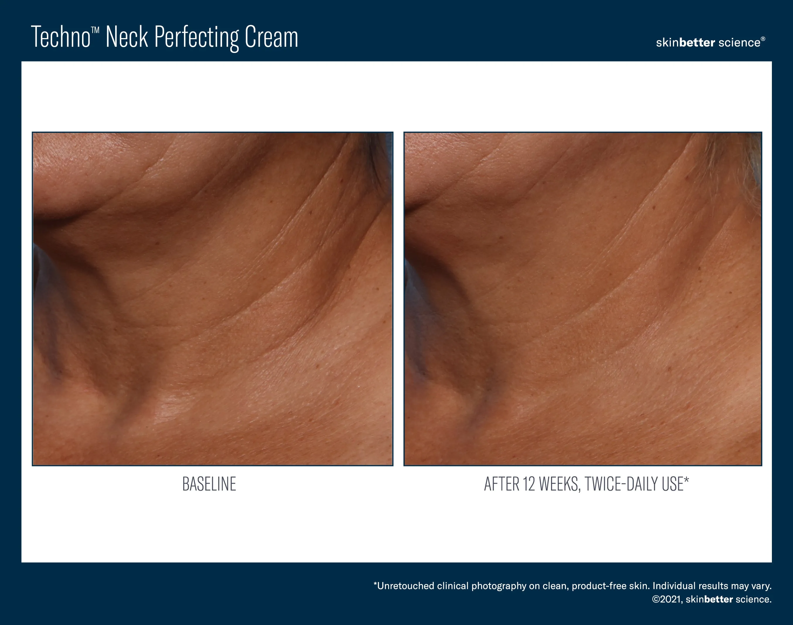 Skinbetter Science Techno Neck Perfecting Cream